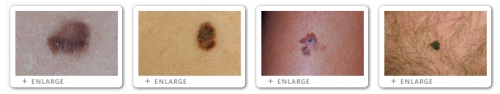 Click to view Melanoma Cell Carcinoma images