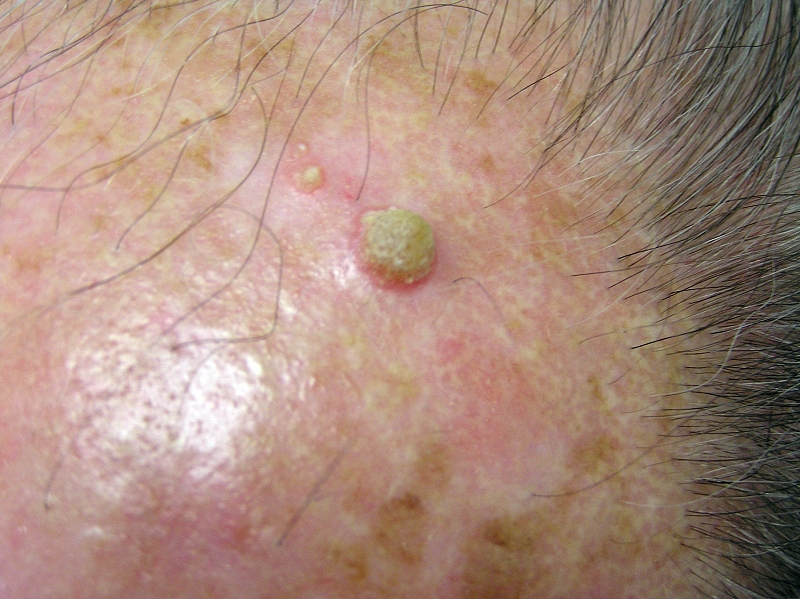 Keratosis actinica, actinische keratose - huidziekten.nl