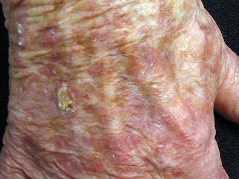 scaly spots on skin #10