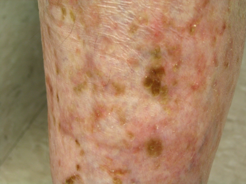 Actinic Keratosis (Solar Keratosis) Picture Image on ...