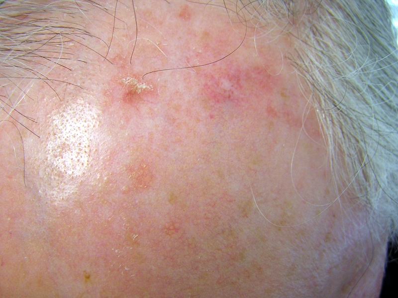 actinic keratosis pictures #10