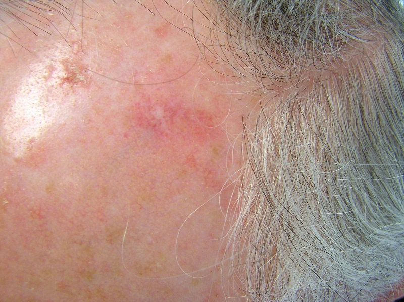 White Spots on Skin | MD-Health.com