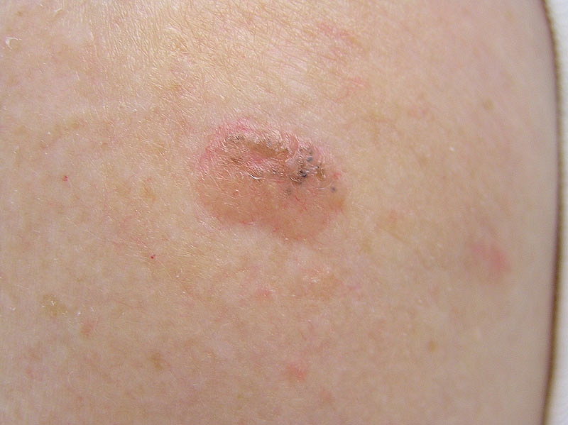 Basal Cell Carcinoma Nose - Dermatology Education