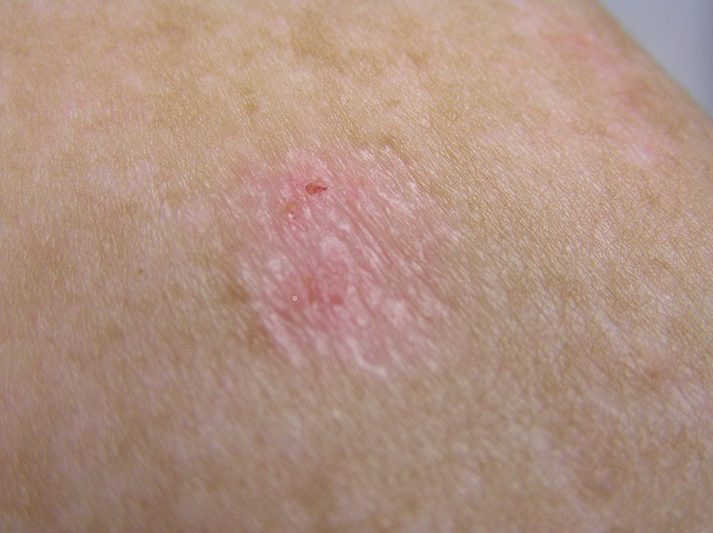 Basal Cell Carcinoma Pictures - Images of Skin Cancer