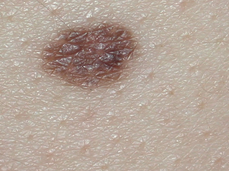 Cancerous Early Stage Cancerous Moles