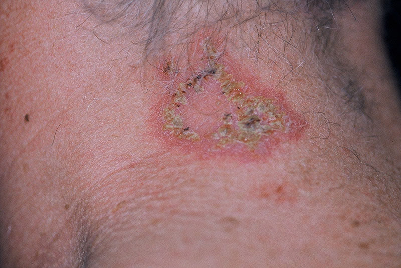 Squamous cell carcinoma - Wikipedia