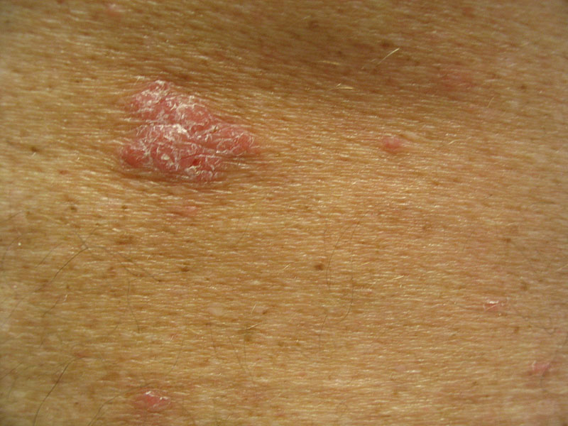 Skin cancer | Photos of skin cancer | Cancer Research UK