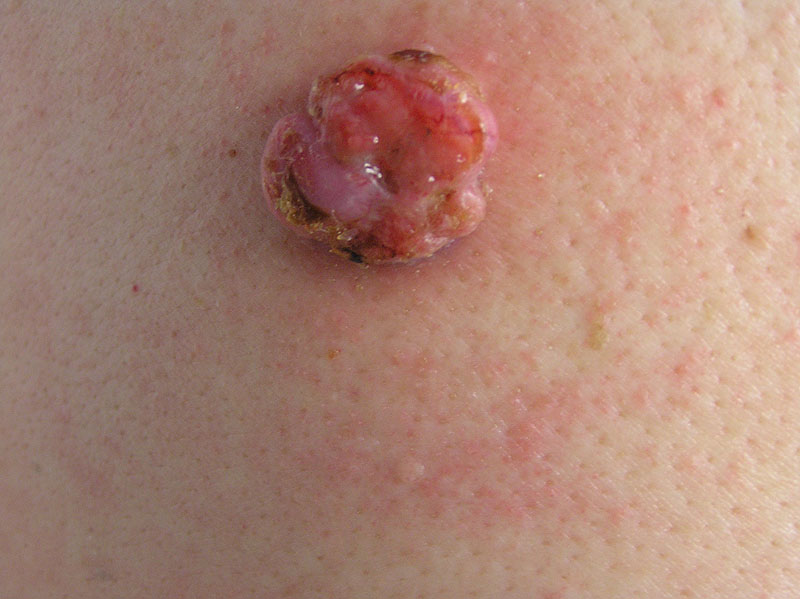 picture of squamous cell carcinoma #11