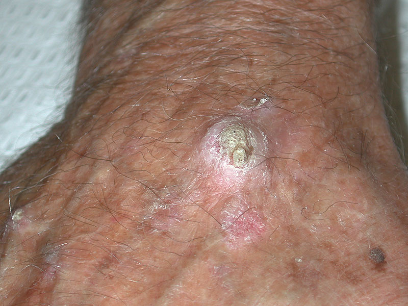 invasive squamous cell carcinoma skin cancer