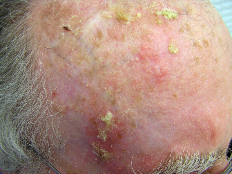 Actinic Keratosis And Skin Cancer