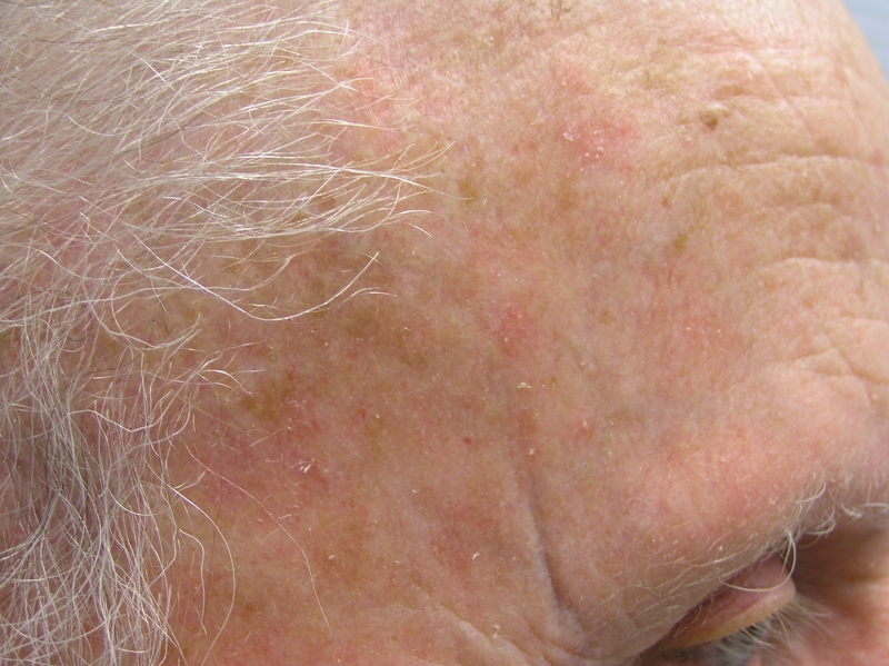 Actinic Keratosis Pictures