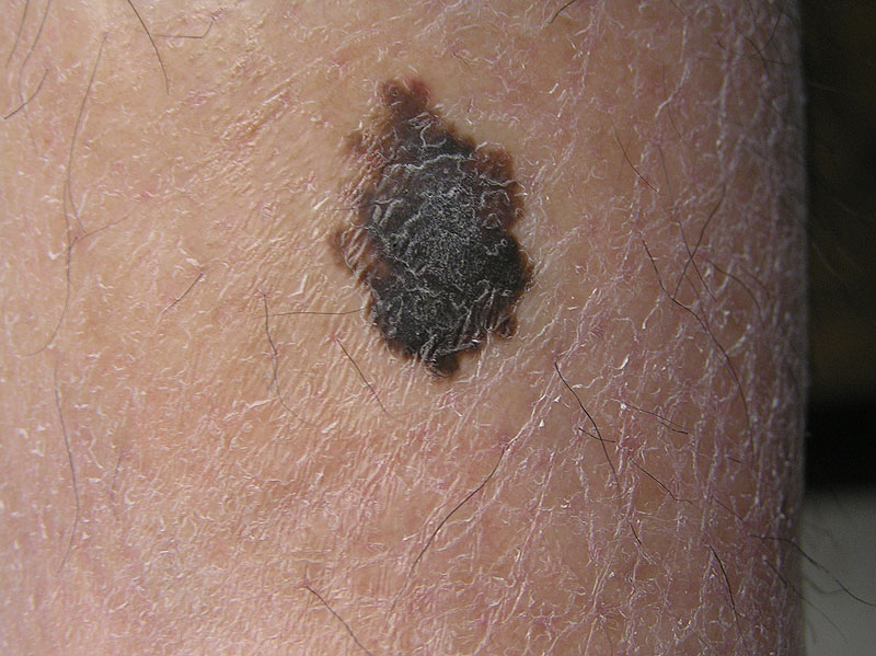 A-B-C-D-E of Melanoma - Learn how to identify melanoma at an early stage